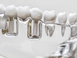 A CIRURGIA GUIADA EM IMPLANTODONTIA